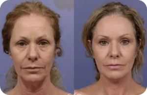 Synevra-Ultra-Lift-Benefits